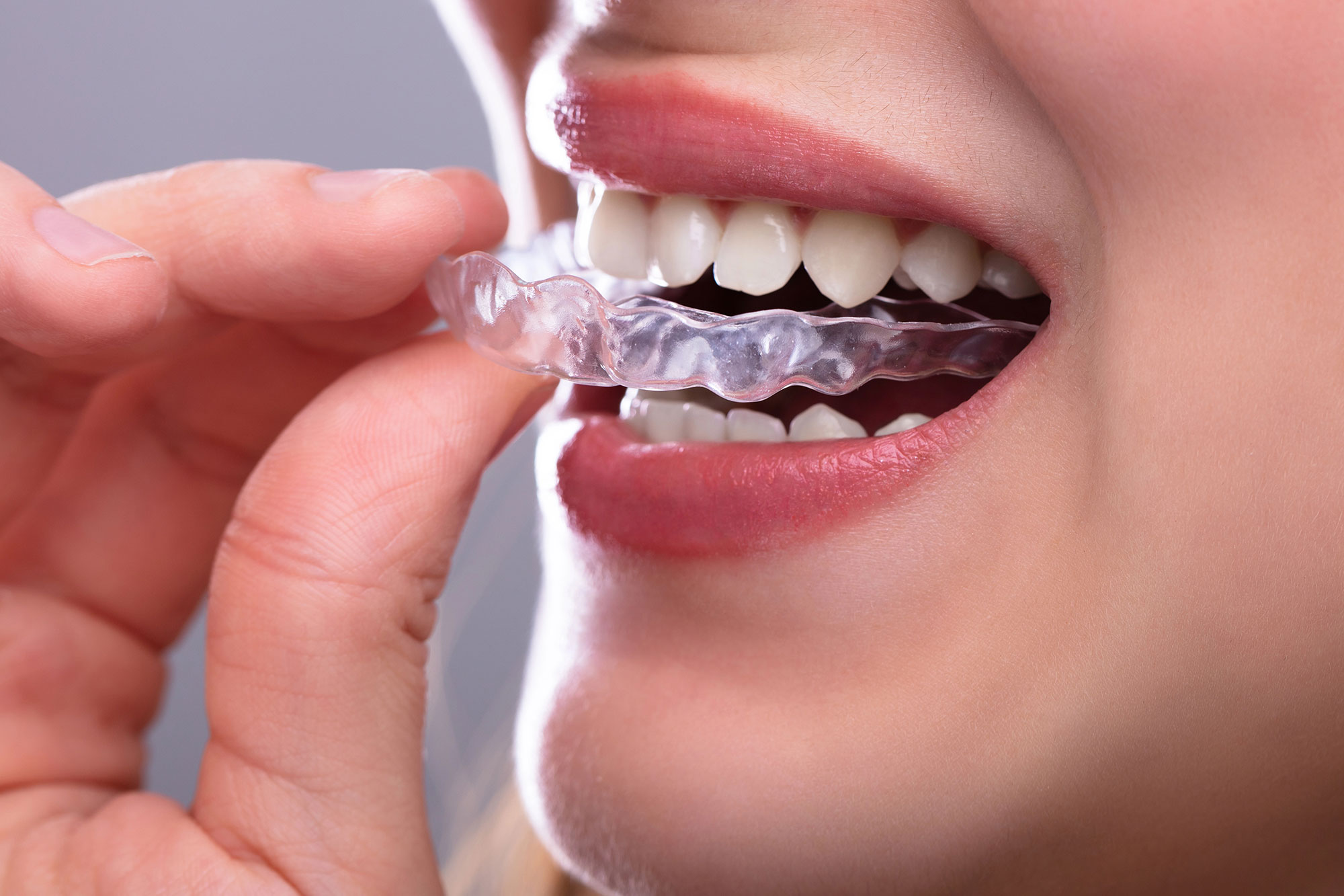 Invisalign vs. Braces